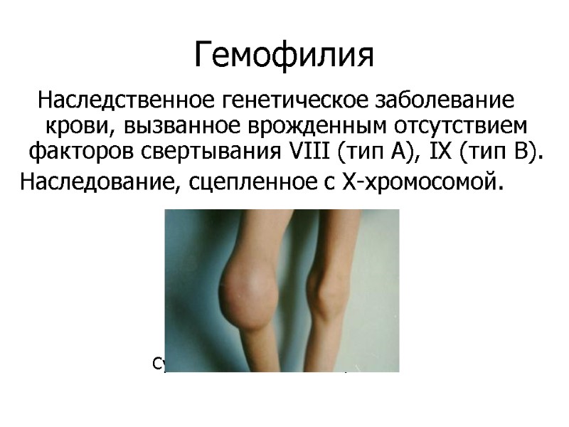 Гемофилия Наследственное генетическое заболевание крови, вызванное врожденным отсутствием факторов свертывания VIII (тип А), IX